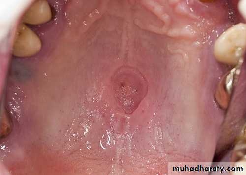Diseases of salivary glands