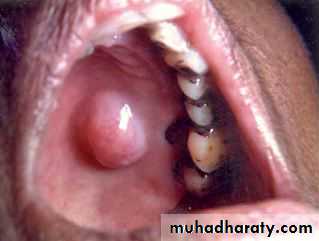 Diseases of salivary glands