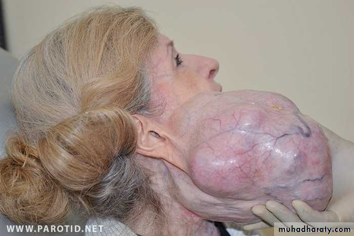 Diseases of salivary glands
