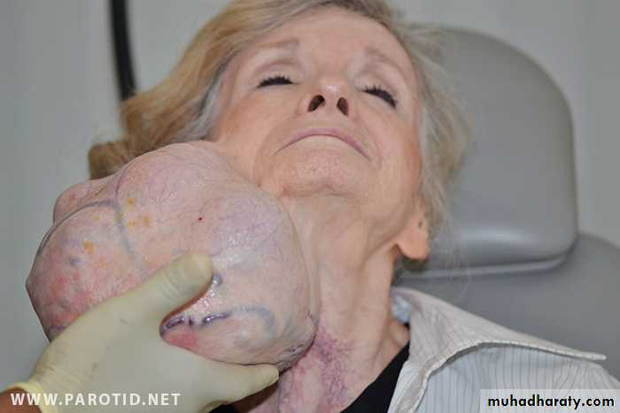 Diseases of salivary glands