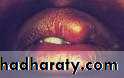 Diseases of salivary glands