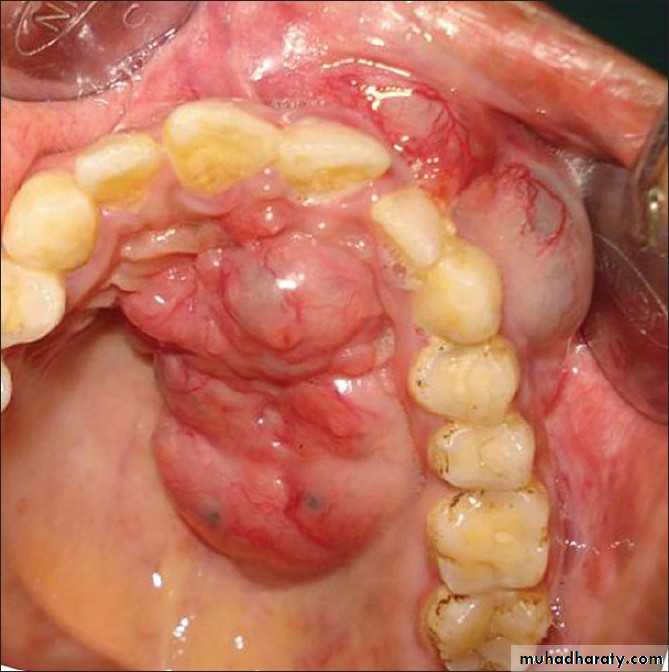 Diseases of salivary glands