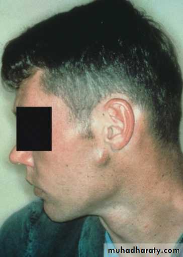 Diseases of salivary glands