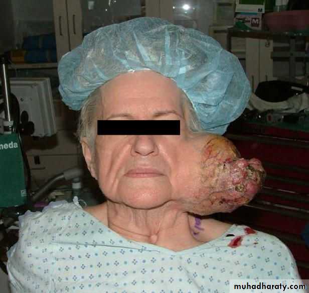 Diseases of salivary glands
