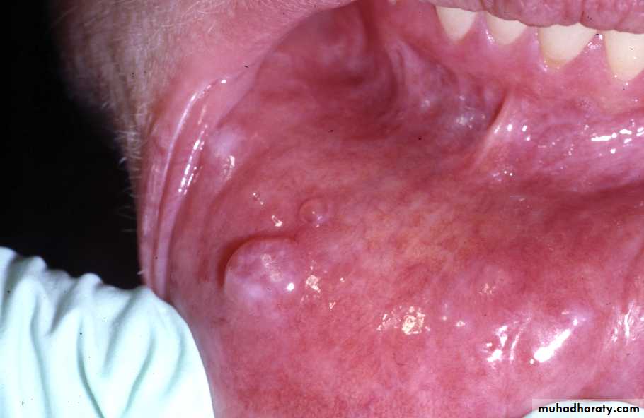 Diseases of salivary glands