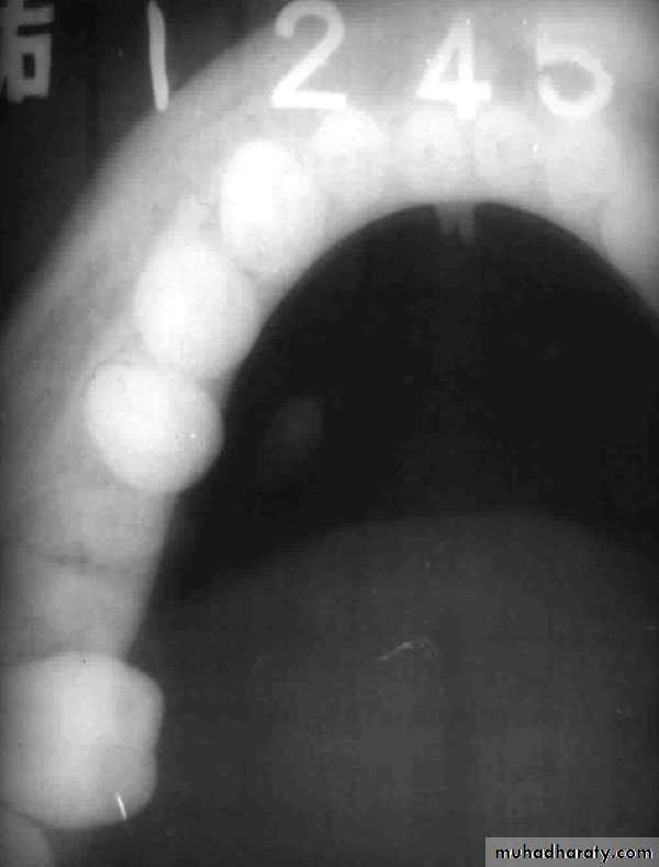 Diseases of salivary glands
