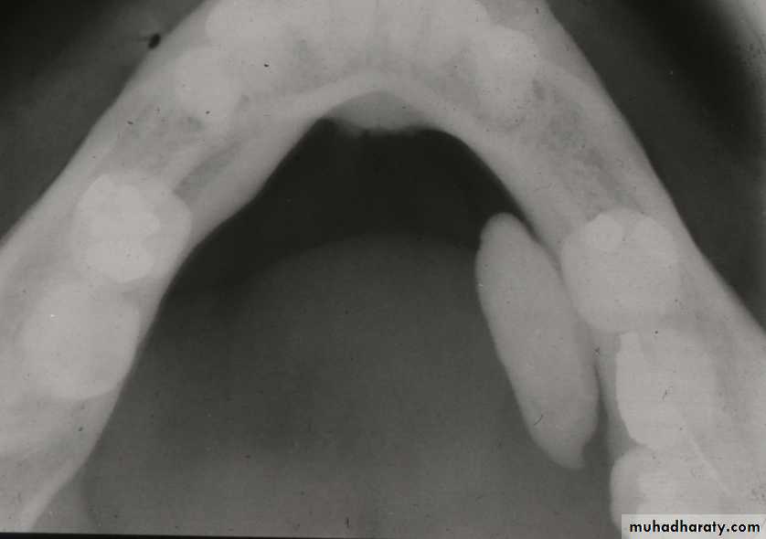 Diseases of salivary glands