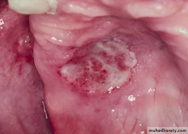 Diseases of salivary glands