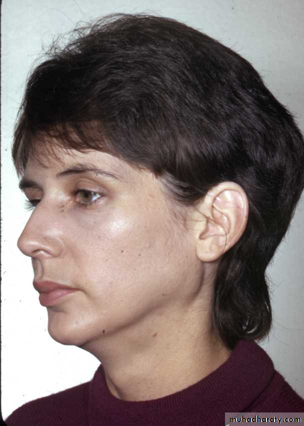 Diseases of salivary glands