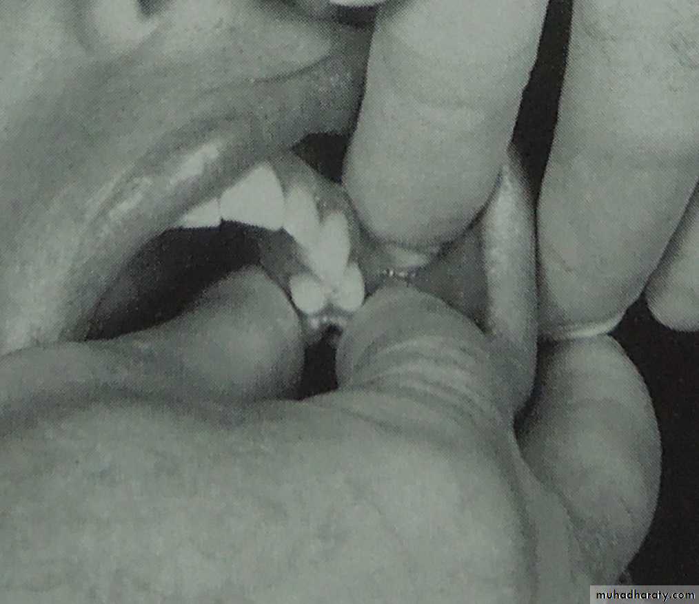 endo