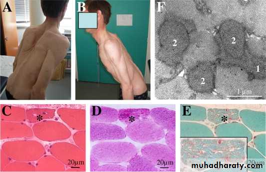 MUSCLE DISEASES ppt