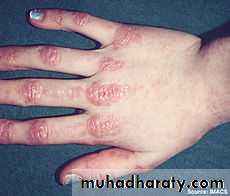 MUSCLE DISEASES ppt