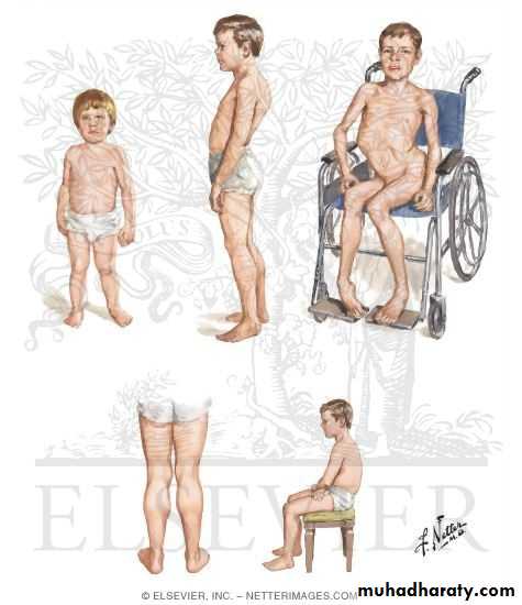 MUSCLE DISEASES ppt