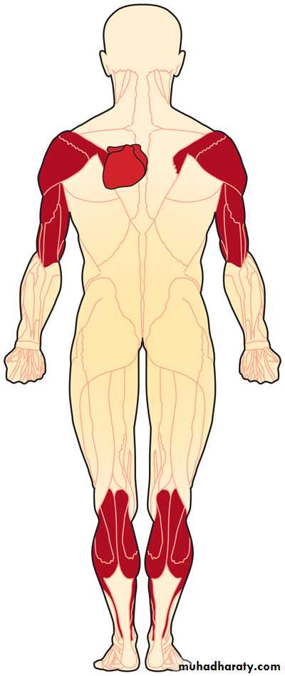 MUSCLE DISEASES ppt