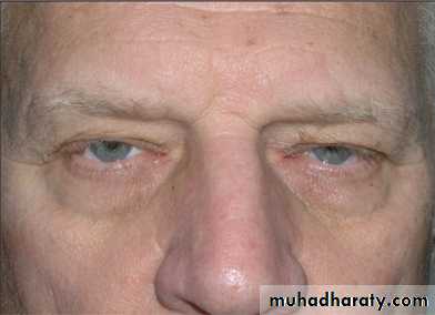 MUSCLE DISEASES ppt