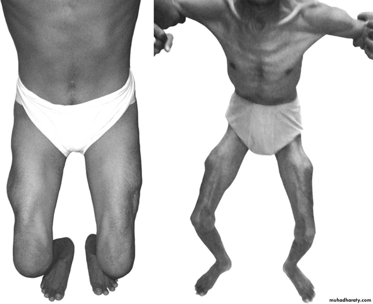 MUSCLE DISEASES ppt