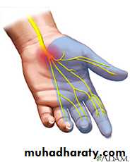 Peripheral Nerve Diseases