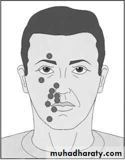 Peripheral Nerve Diseases