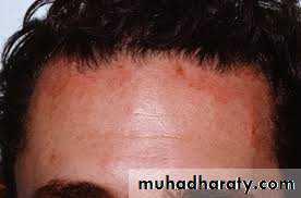 Eczema