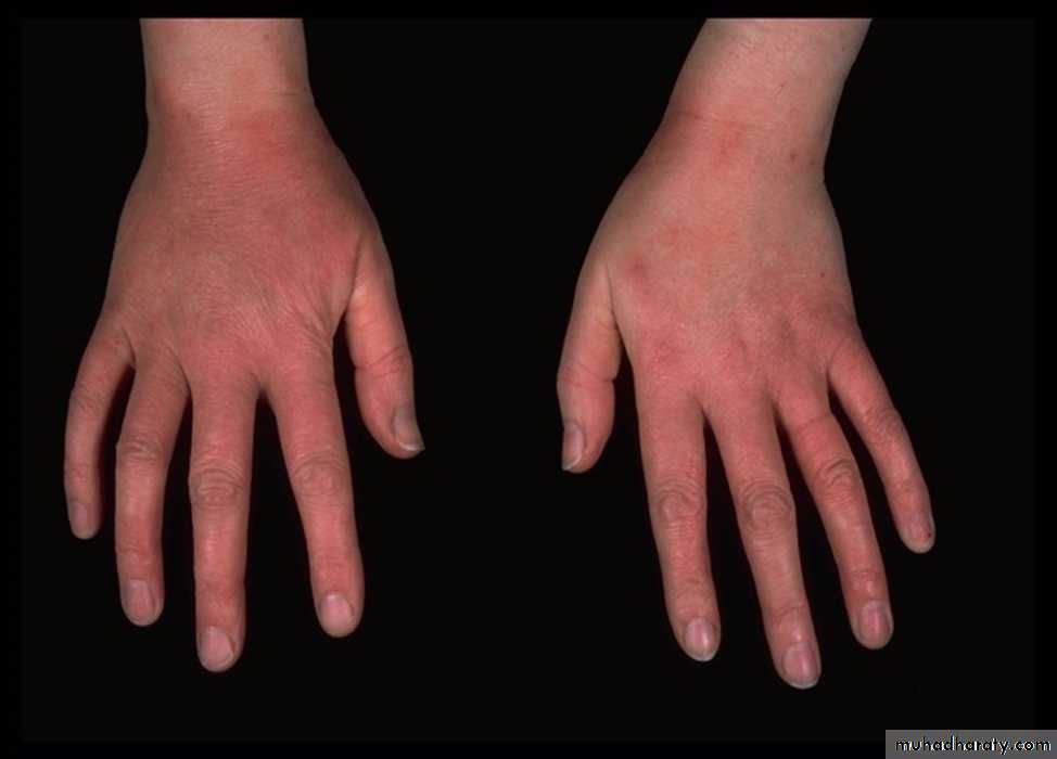 Eczema