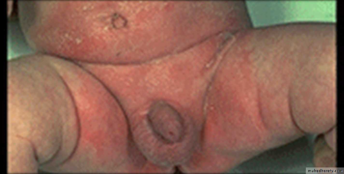 Eczema