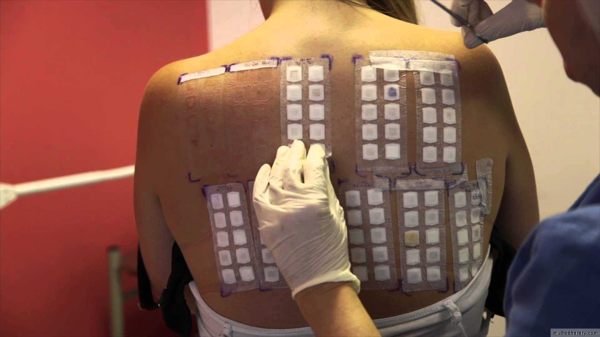 Eczema