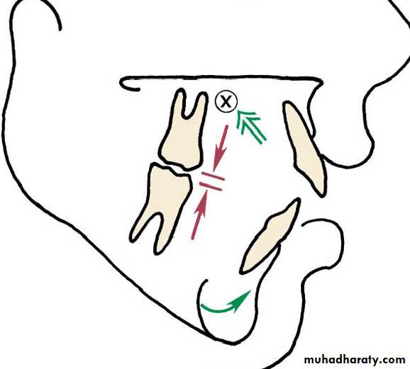 Open Bite