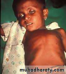 ACUTE GASTROENTERITIS