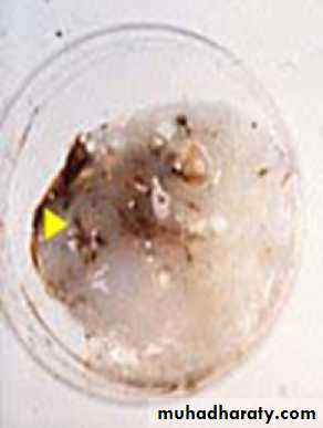 Pneumonia