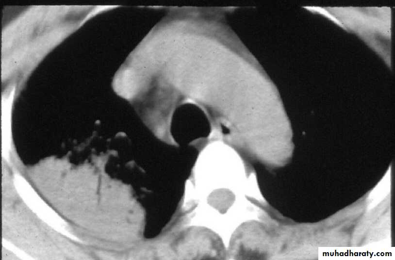 Pneumonia