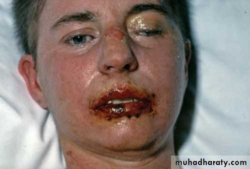 Pneumonia