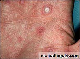 Pneumonia