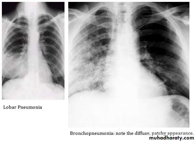 Pneumonia
