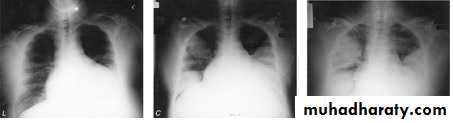 Pneumonia