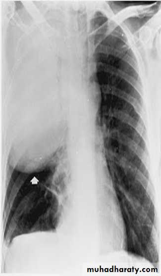 Pneumonia