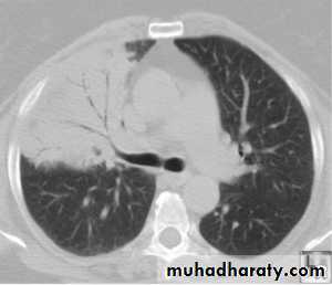 Pneumonia
