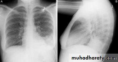 Pneumonia