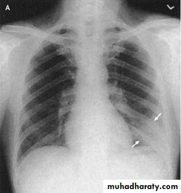 Pneumonia