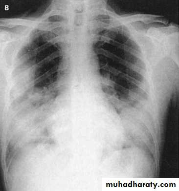 Pneumonia