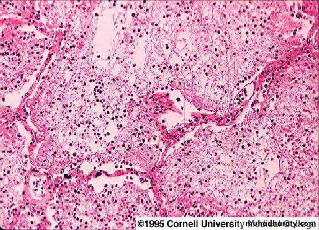 Pneumonia