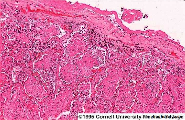Pneumonia