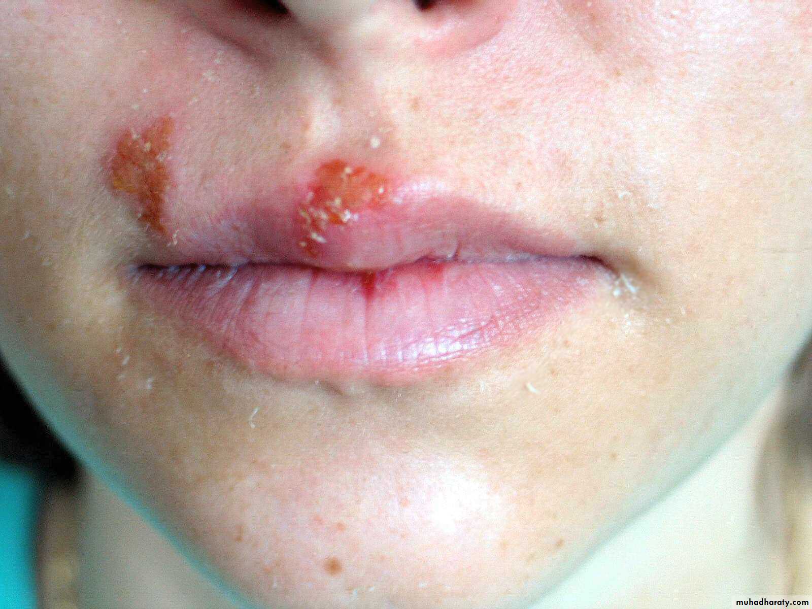 Pneumonia