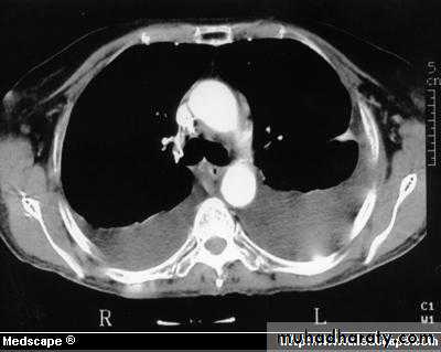 Pleural effusion
