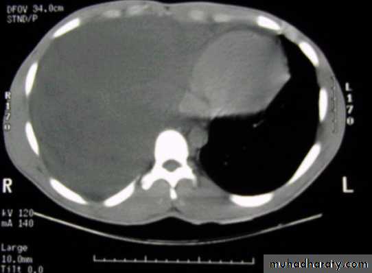 Pleural effusion