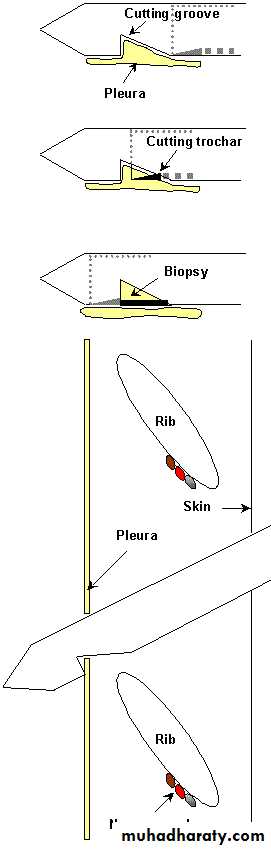 Pleural effusion