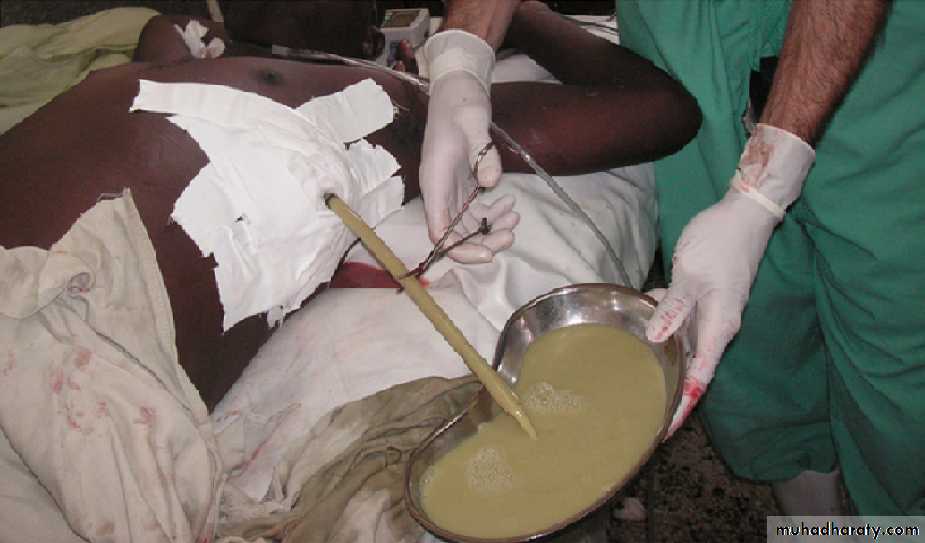 Pleural effusion