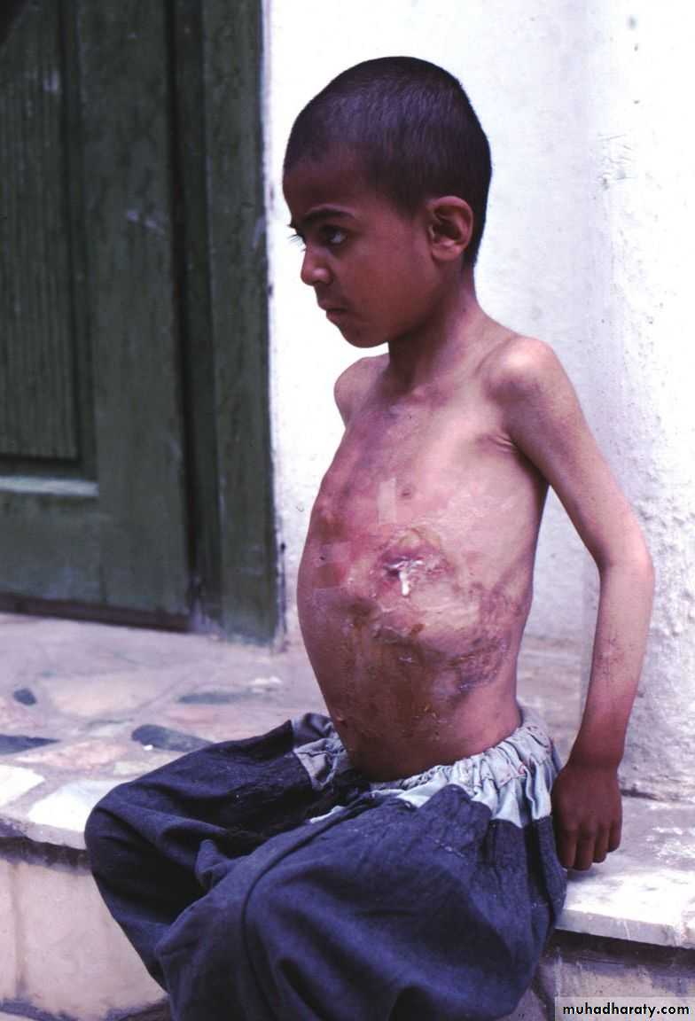Pleural effusion
