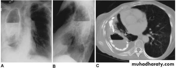 Pleural effusion