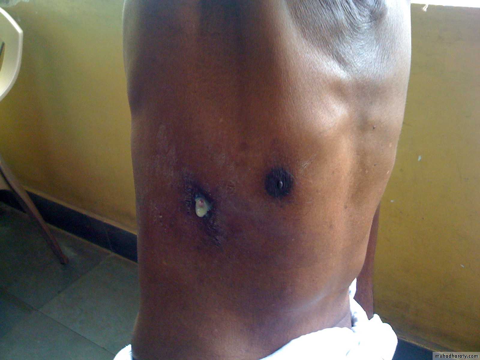 Pleural effusion