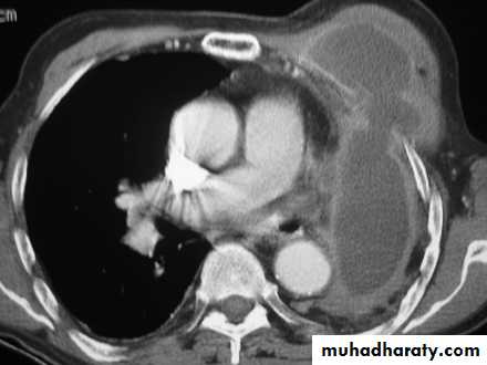 Pleural effusion
